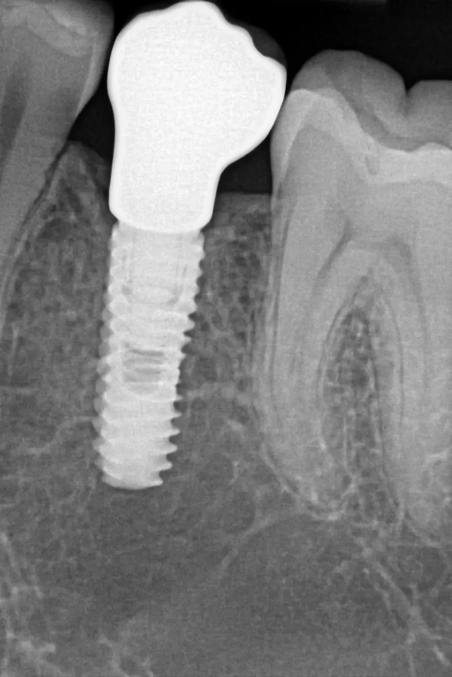 RTG intraoralna slika dentalnog implantata