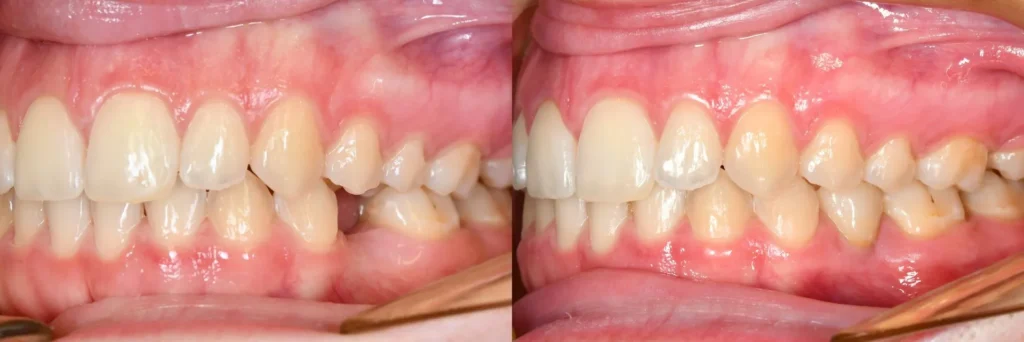 dentalni implantat prikaz slučaja