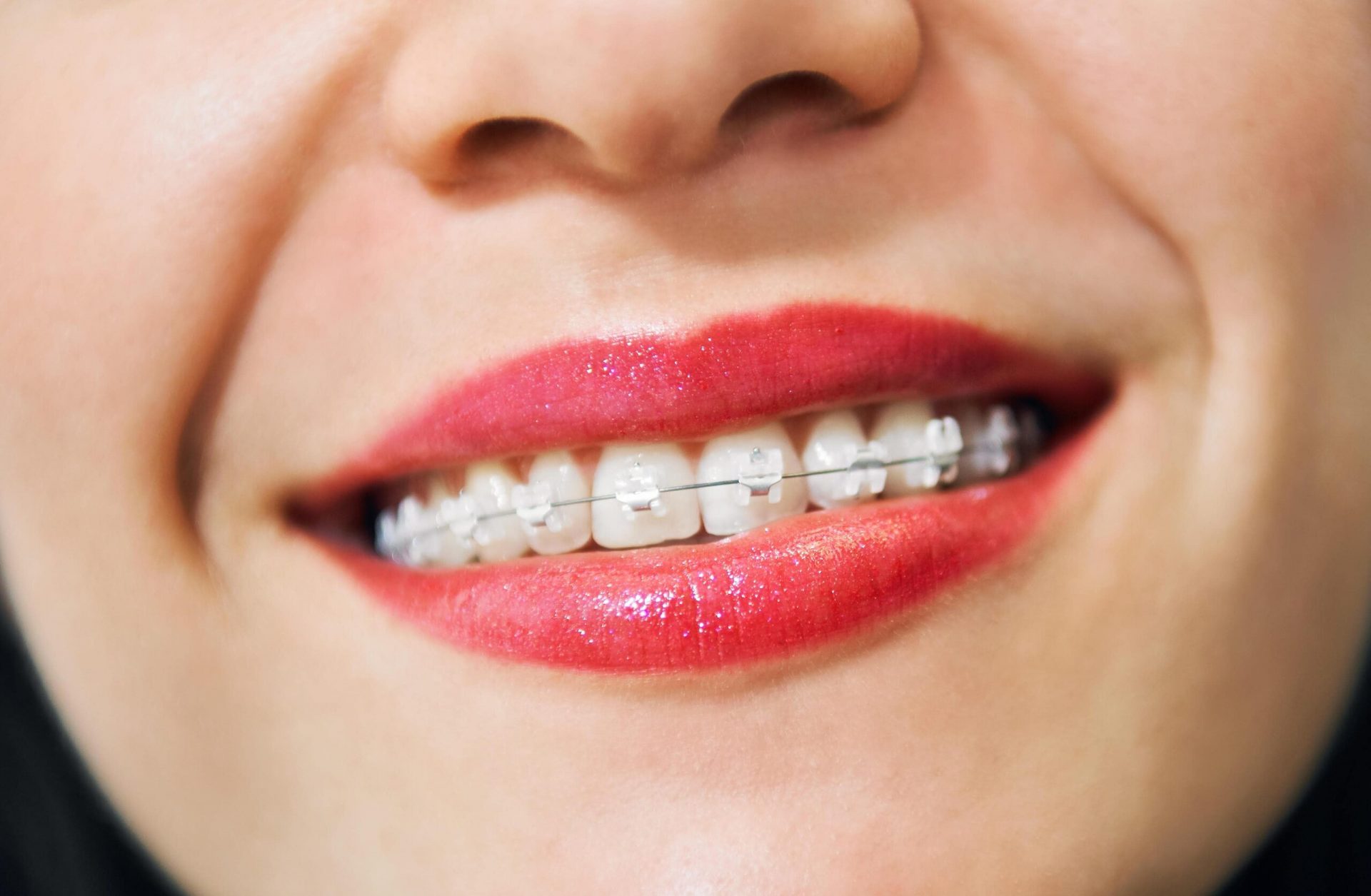 Ortodontska terapija