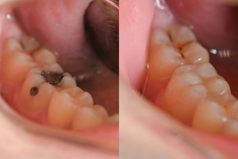 zamjena stare plombe i uklanjanje karijesa prije i poslije kompozitnog ispuna